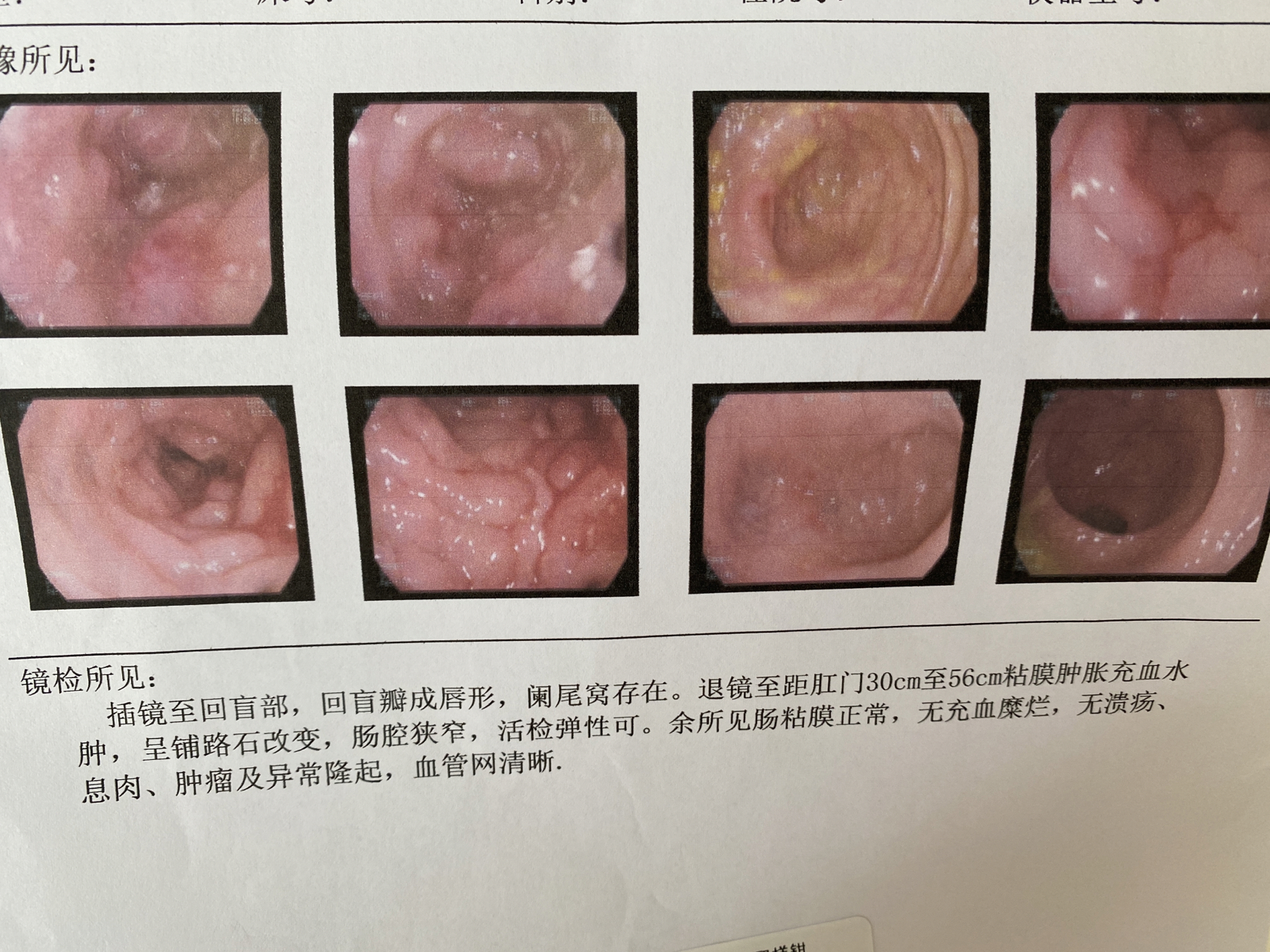 克罗恩病最新消息全面解析，了解并跟上研究新进展的指南